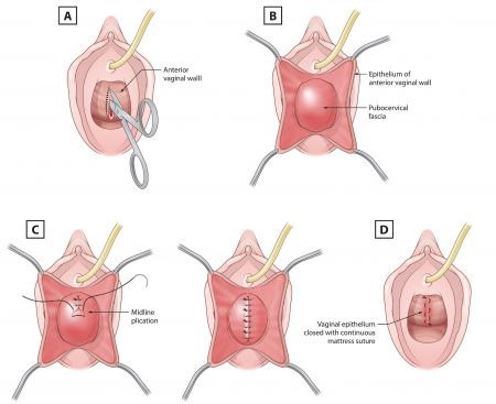 Anterior