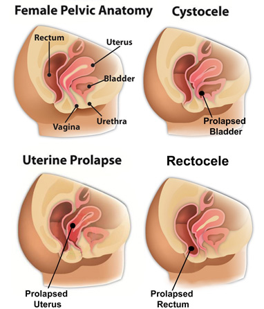 Anterior vaginal prolapse (cystocele) - Diagnosis and treatment - Mayo  Clinic