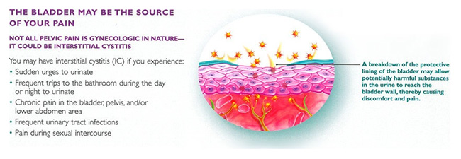 Interstitial Cystitis