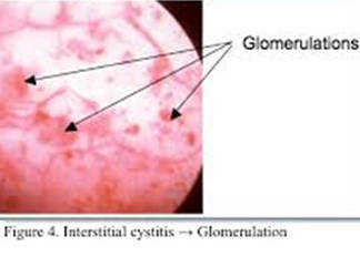 Interstitial Cystitis