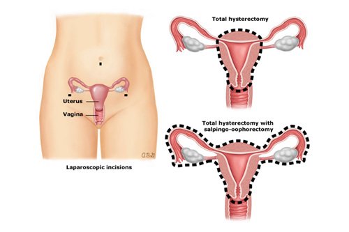 LAVH procedure