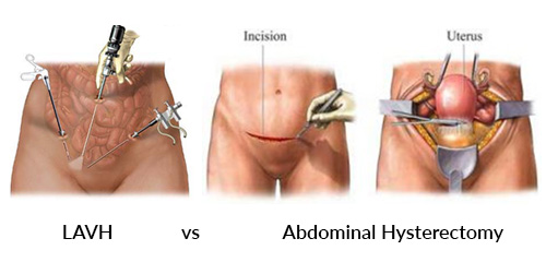LAVH vs Abdominal Hysterectomy