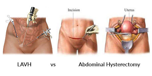 laparoscopic hysterectomy before and after