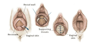 A large posterior vaginal wall cyst simulating rectocele: an account of an  unusual perplexing case - Document - Gale Academic OneFile