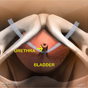 bladder sling