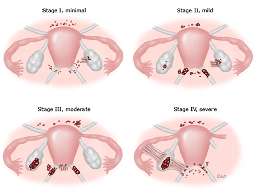 endomentriosis