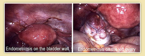 endometriosis