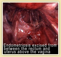 endometriosis