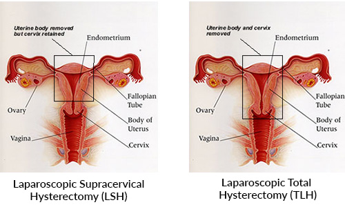 LAVH vs LSH procedure