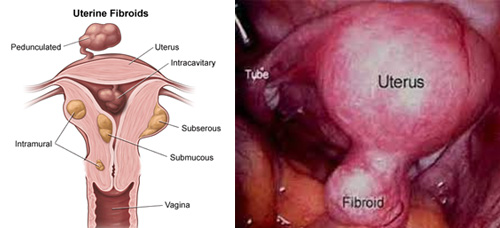 myomectomy