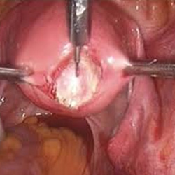 myomectomy