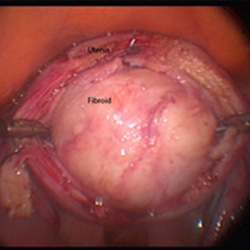 myomectomy