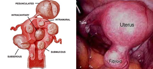 myomectomy