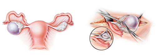 ovarian cystectomy