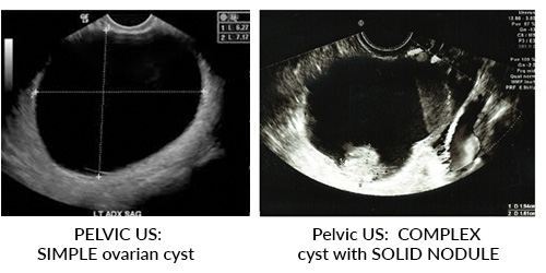 simple vs comples cyst