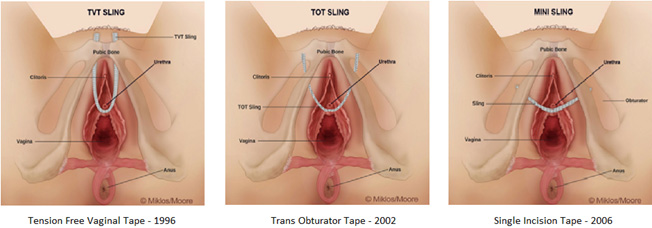 bladder sling