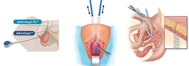 bladder sling